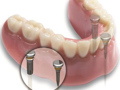 种植牙的十大危害有哪些,种植牙十大危害图片