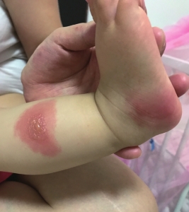 娃娃被蚊子叮咬后全身长满红色小疙瘩,秋蚊子咬人更“狠毒”