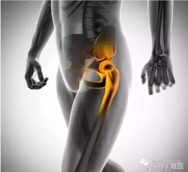 容易误诊成股骨头坏死的疾病,磁共振股骨头坏死有没有可能误诊