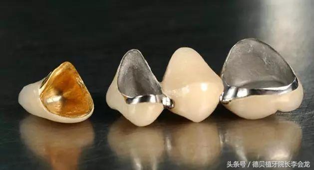 几百元一颗牙齿,几百一颗的牙贴面好吗