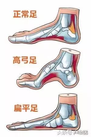 一个小技巧防止崴脚运动损伤,预防运动崴脚的正确做法