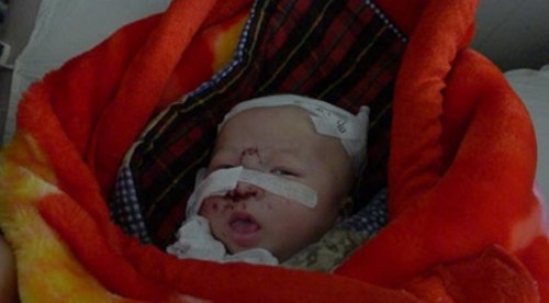 老鼠咬伤手指需要打狂犬疫苗吗,老鼠咬伤后多久打疫苗