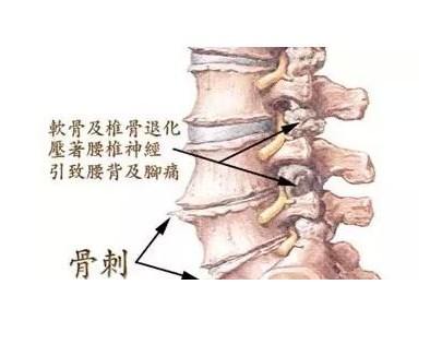 腰椎间盘突出按严重程度如何分类,腰椎间盘突出十种治疗方法