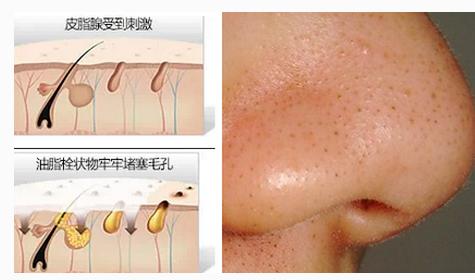 去黑头的最好办法是什么,水杨酸去黑头的正确使用方法