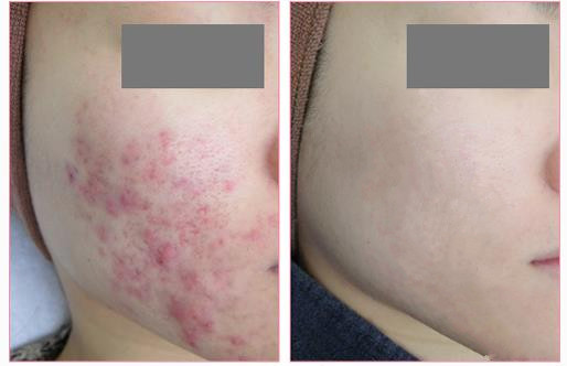 红蓝光治痘痘方法,红蓝光祛痘痘效果怎么样