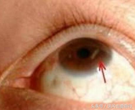 血脂高不高看这6处的表现,血脂高不高看哪几项指标