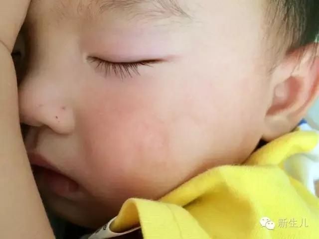 新生儿宝宝红疹子怎么引起的,新生儿皮肤起红疹子怎么办