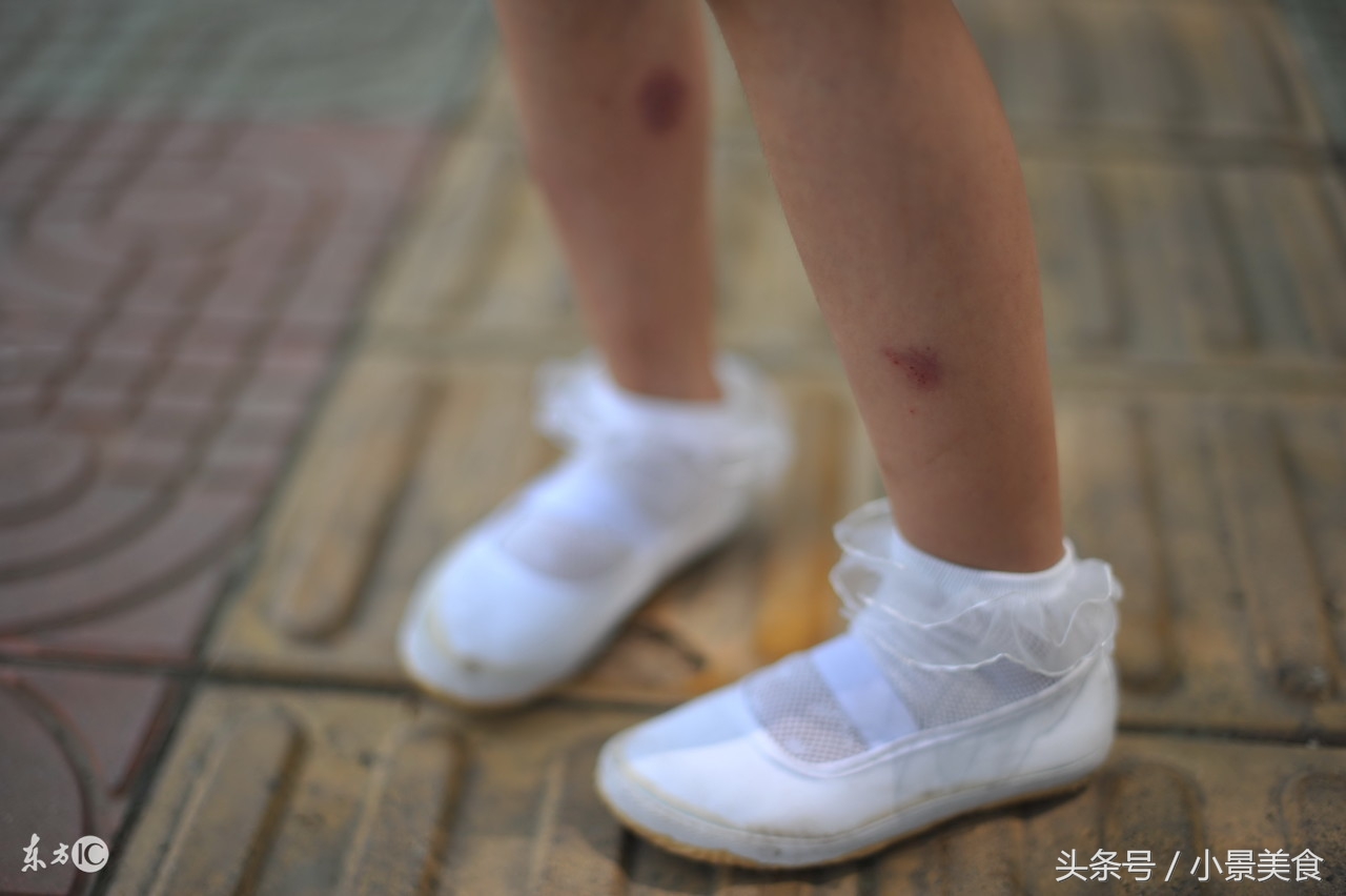 皮肤科医生对付*麻疹荨**的神器，你用过没用？