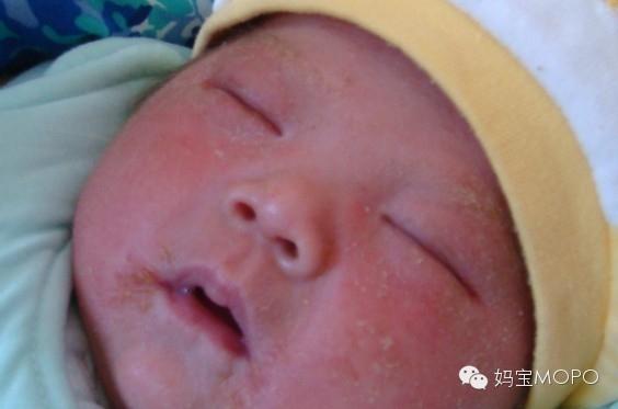 湿疹最怕的五种方法,湿疹高发做好这几点避免反复发作