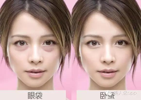 分不清是哪种黑眼圈,分不清楚是眼袋还是黑眼圈