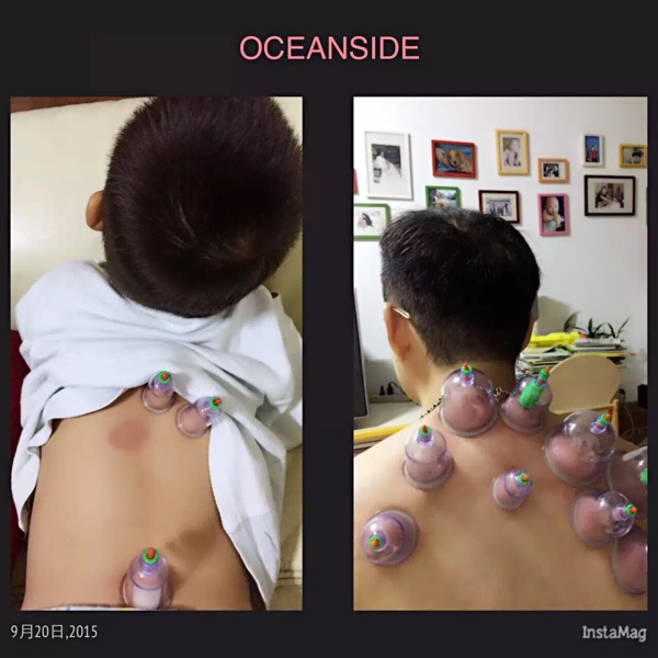 宝宝咳嗽不吃药推拿,宝宝咳嗽不打针可以治疗吗