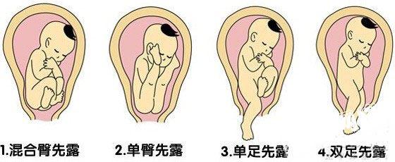胎儿顶先露和臀先露是什么意思,孕妇脐带先露有什么危害