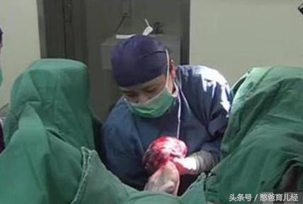 顺产的宝妈都知道要备皮,可是剖腹产也需要备皮吗?