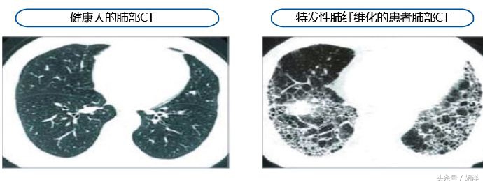 怪病-肺部长得像丝瓜，不但充满大泡小泡，还逐渐硬化，不能伸展