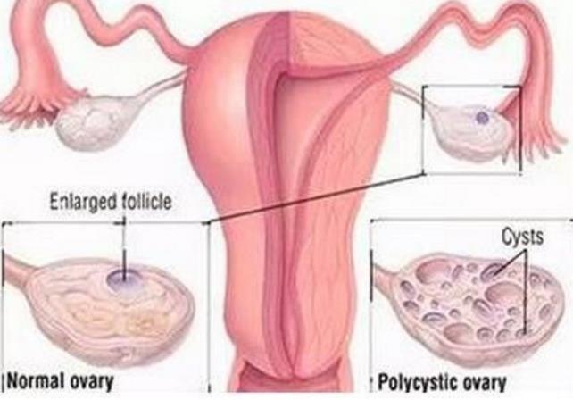 “痘妞”、“毛妹”,小心多囊卵巢综合征!(附靠谱的三甲医院名单)