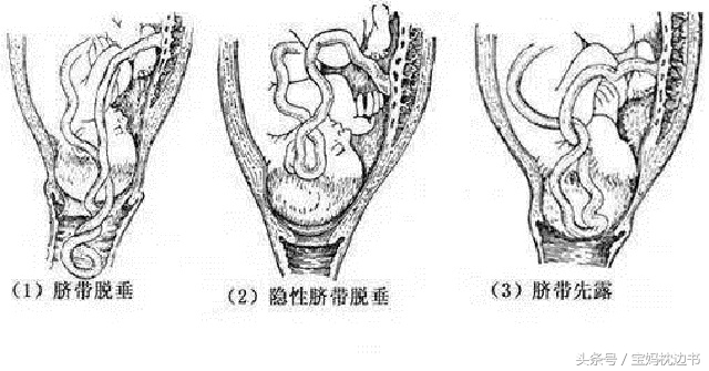 分娩期孩子头朝下,分娩头先出来还是脚先出来
