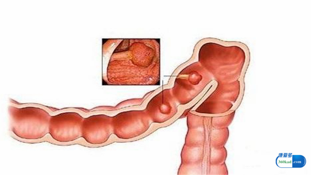 复方斑蝥胶囊治什么癌,复方斑蝥胶囊治癌效果好吗