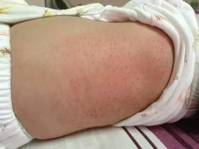 婴儿后背的黑刺多久消失,宝宝后背擦出刺的东西