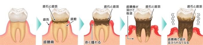 牙齿矫正牙齿整齐了，却出现了难看的黑三角？我们应该如何避免！