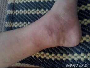 怀孕初期腿上青筋会跳明显吗,生完小孩小腿有条黑线是怎么回事