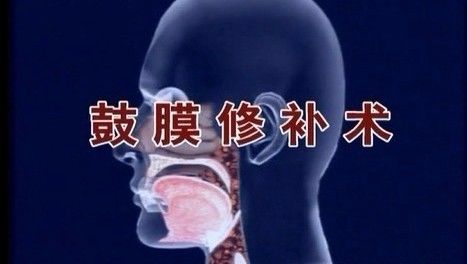 鼓膜挫伤听力下降,鼓膜外伤怎么处理
