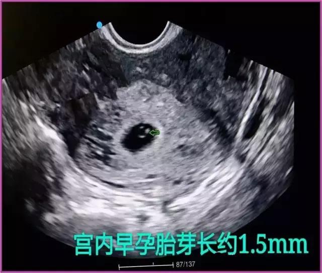 B超彩超有什么区别,妇科b超和阴超的区别