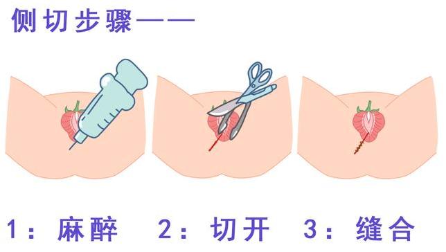 如何做到顺产无侧切无撕裂,两胎都是超快顺产无侧切无撕裂