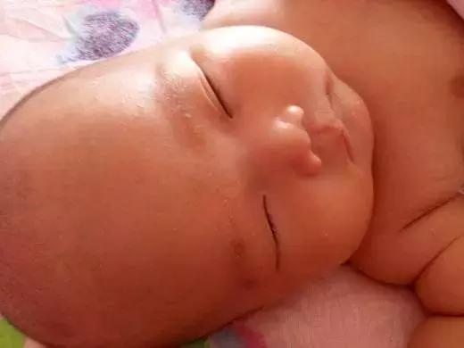 如何区分痱子和湿疹婴儿,湿疹和痱子怎么判断