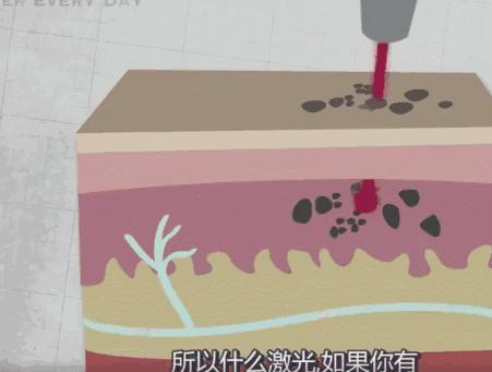 激光洗纹身需要修复吗,纹身后悔了怎么办啊