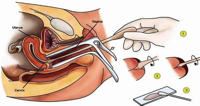 宫颈癌子宫全切手术费用多少,宫颈癌前病变二级手术费用多少