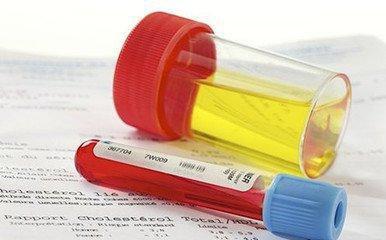 尿液异常原因有哪些,尿液异常应该去什么科