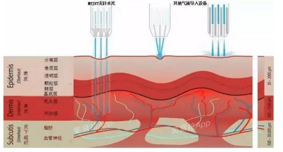 痘痘粉刺怎么根治,粉刺没有处理好变成硬疙瘩