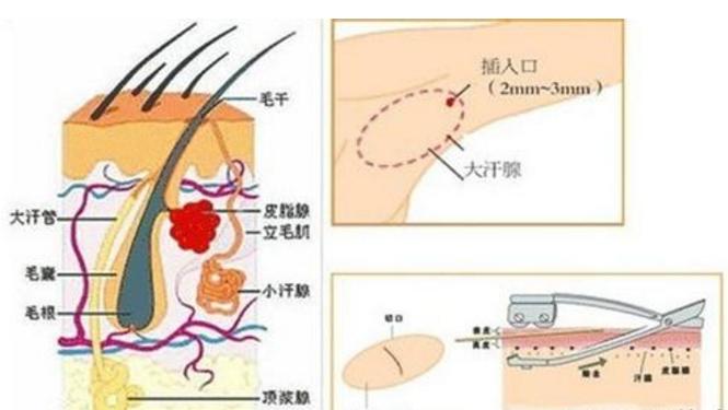 腋臭的原因治疗方法,腋臭的原因及消除腋臭的8个方法