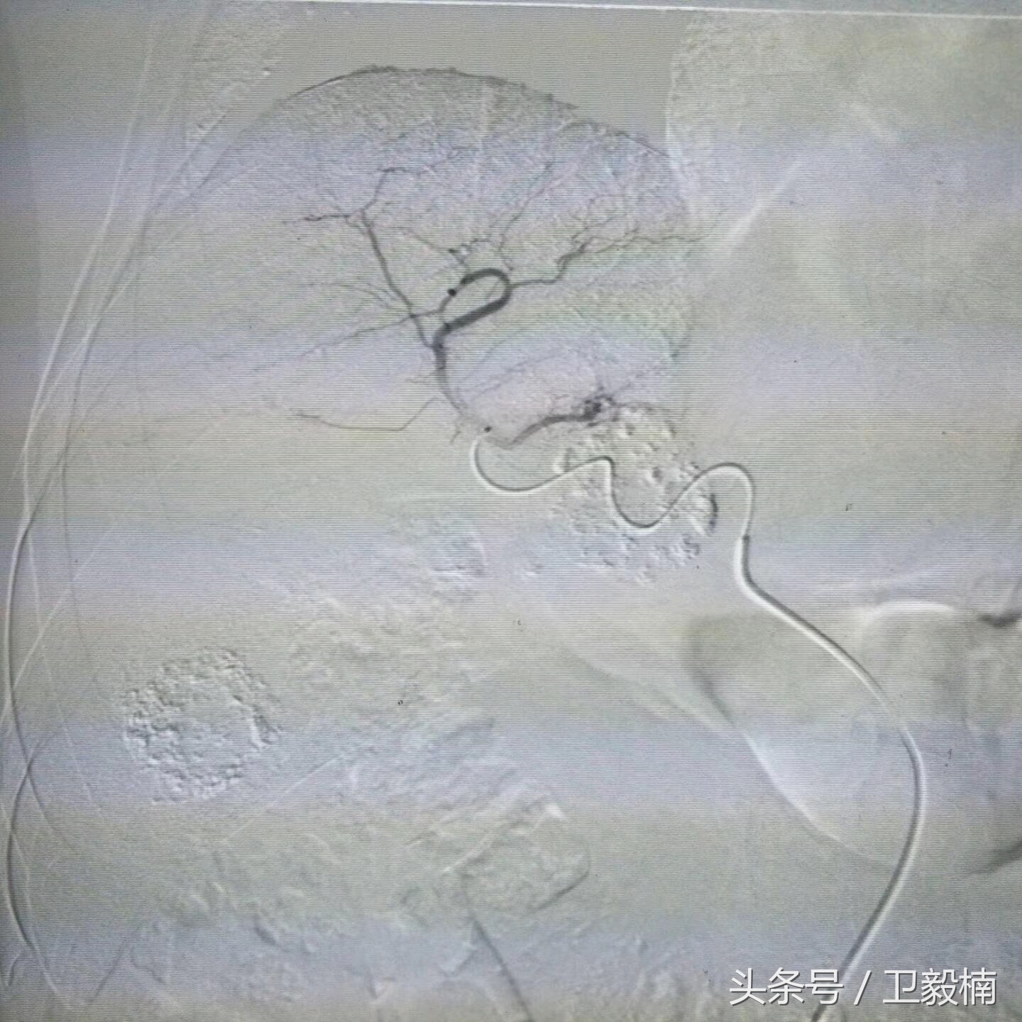 微创介入科一卫毅楠,卫毅楠运城介入治疗
