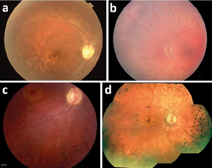 fda批准的抗痴呆药物,fda批准糖尿病细胞疗法
