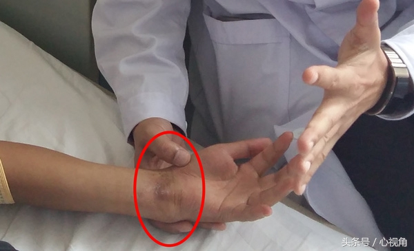 骨折后自行包中草药治疗,3个月后左腕部出现畸形