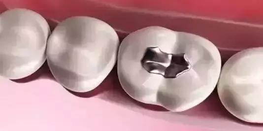 同样是补牙价格为什么差很远,同样补牙为什么报销不一样