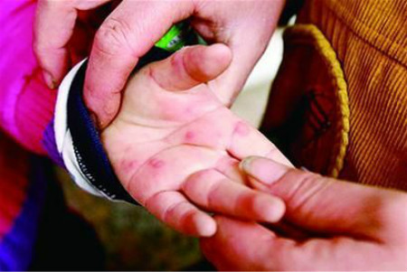 幼儿手上长红点,幼儿手上有红点是怎么回事