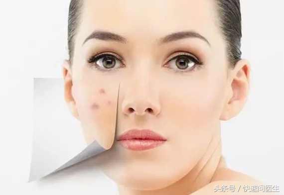 下巴鼻翼长痘痘是什么原因引起的,鼻翼下巴长痘痘是什么原因