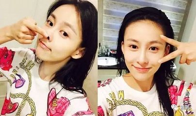 隆鼻后很疼,隆鼻后单纯的肿胀没有疼痛的感觉