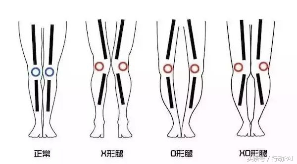 如何改善xo型腿让腿又细又长又直,腿不直o型腿的矫正方法