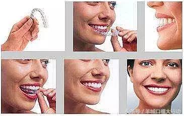 隐形矫正牙齿的注意事项,隐形牙套佩戴注意事项短视频