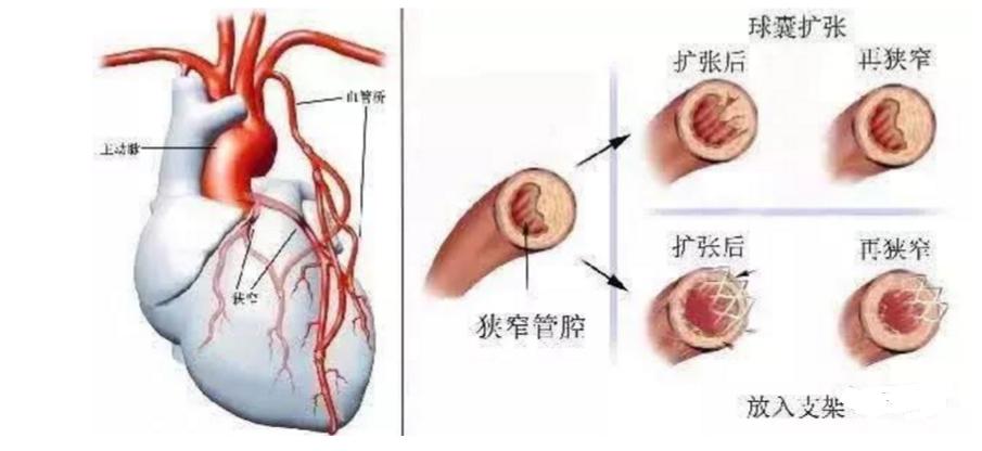 太极拳站桩治疗脑梗塞吗,站桩对心脑血管病有帮助吗