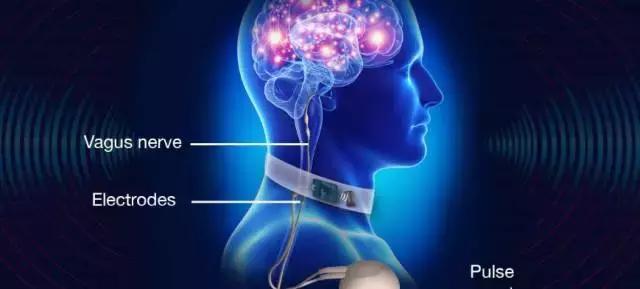 迷走神经电刺激疗法的作用是,迷走神经刺激术治疗副作用