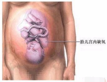 剖腹产手术全过程图解，需要切开7层才能将宝宝取出