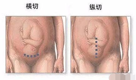 剖腹产手术全过程图解，需要切开7层才能将宝宝取出
