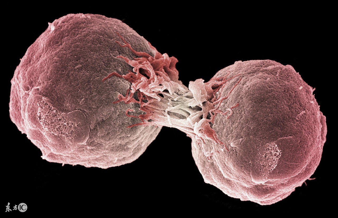 眼眶假性淋巴瘤病因,侵袭性淋巴瘤的病因