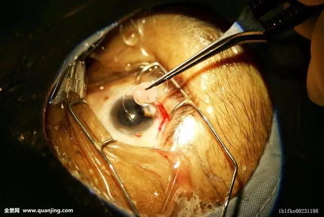 近视的干预和防治手段,近视各种疗法