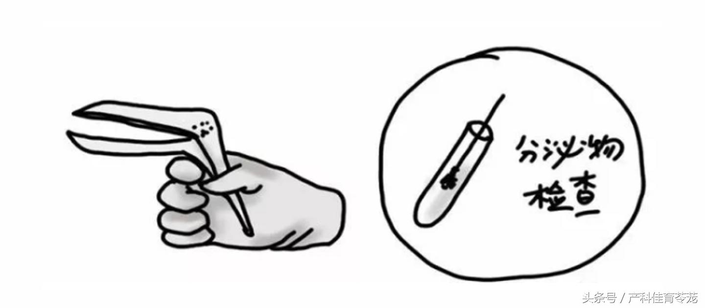 放置宫内节育器请什么假,宫内节育器放置全过程