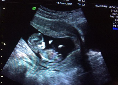 女性胎停育越来越多，孕期这几件小事可要留意了！